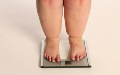 Lipödem oder nur dicke Beine – Eine wichtige Unterscheidung