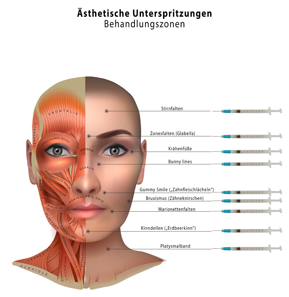 Behandlungszonen mit Muskelrelaxans (Botulinumtoxin)