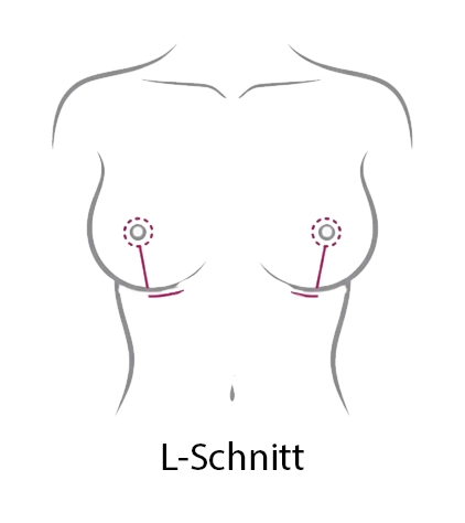 L-Schnitt-Technik