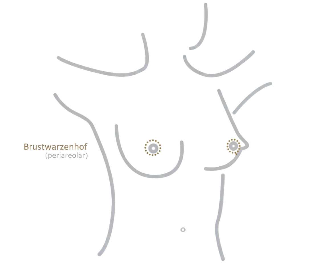 Schnitttechnik am Brustwarzenrand