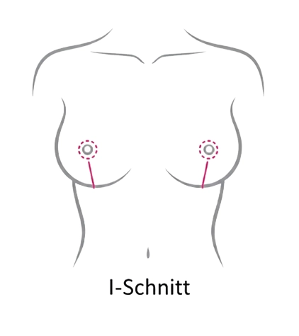 I-Schnitt Technik