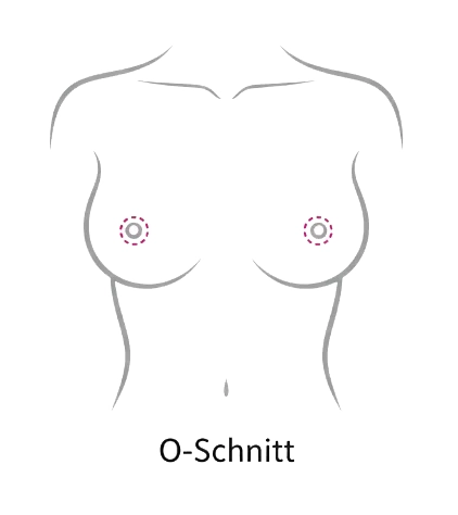 Periareoläre Straffung (O-Schnitt)
