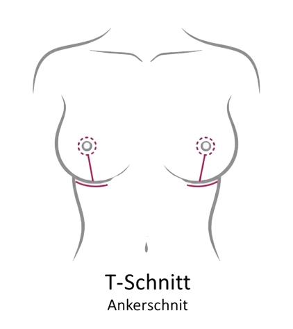 T-Schnitt (Ankerschnitt)