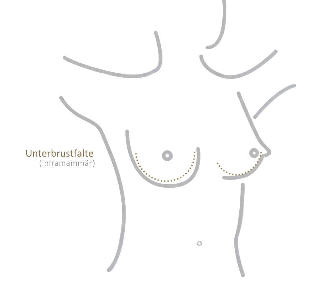 Schnitttechnik unterhalb der Brust