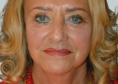 Facelift Nachher Bild