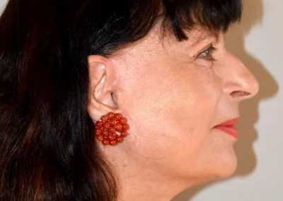 Facelift Nachher Bild