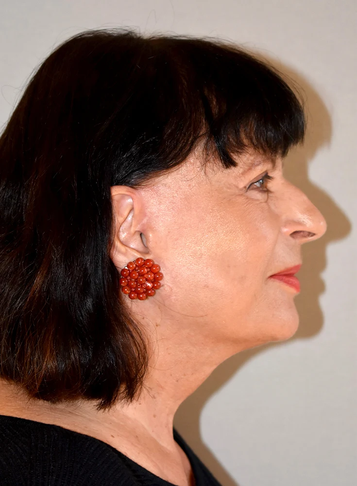 Facelift Nachher Bild 3