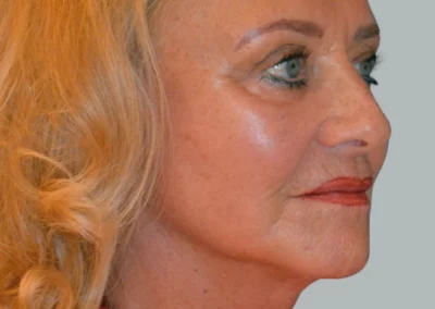 Facelift Nachher Bild