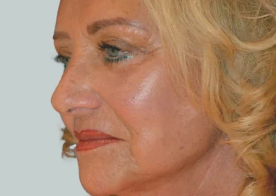 Facelift Nachher Bild