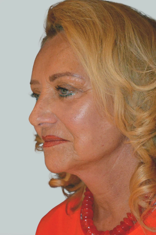 Facelift Nachher Bild 2