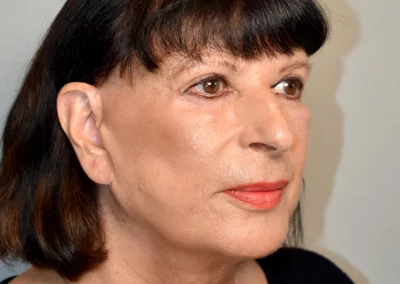 Facelift Nachher Bild