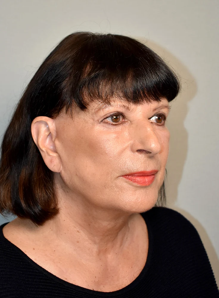 Facelift Nachher Bild 2