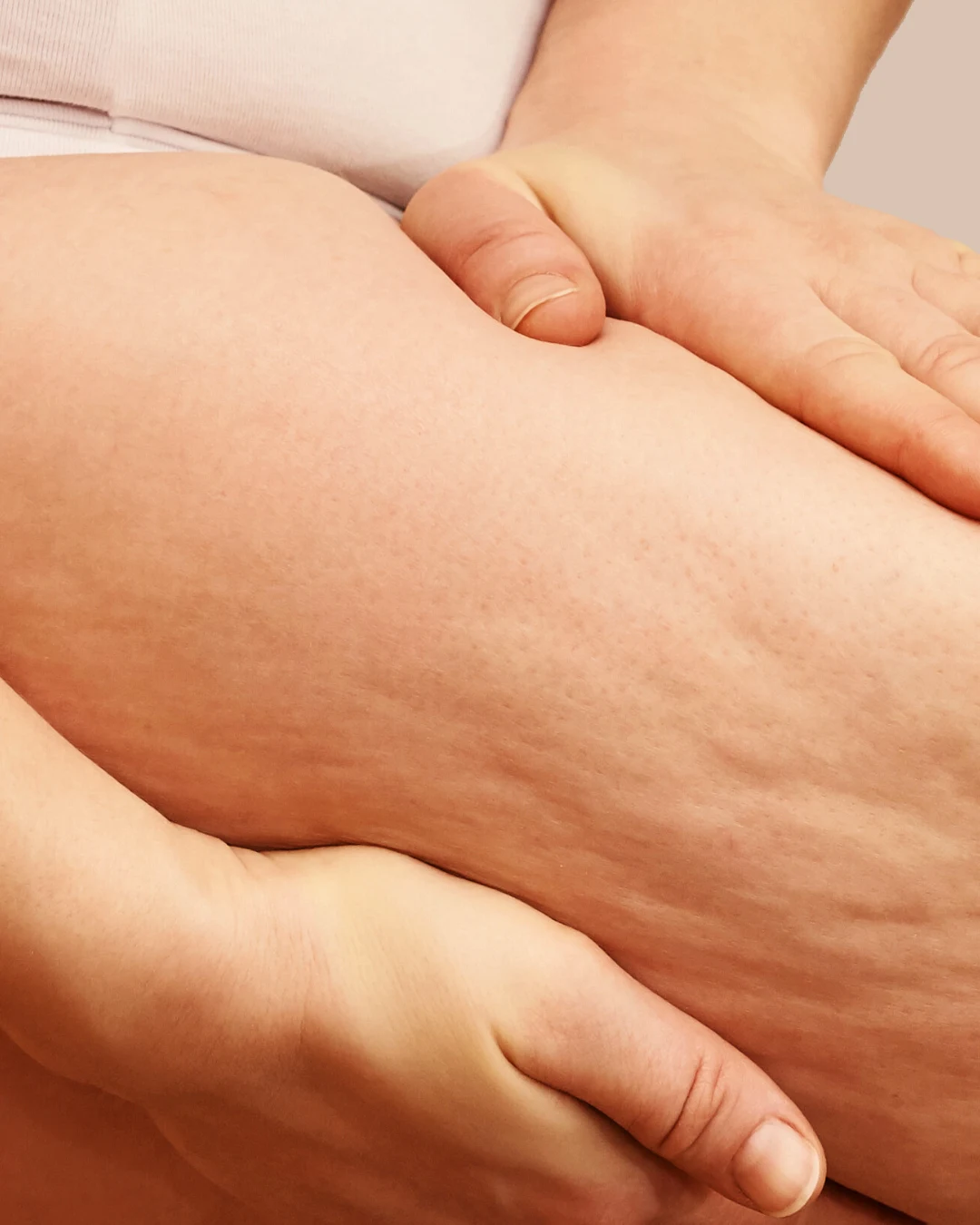 Anzeichen für Lipödem am Oberschenkel