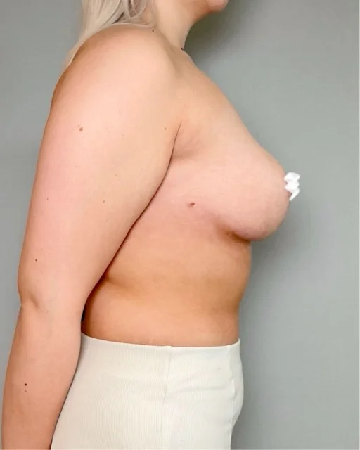 Bruststraffung mit Lipofilling
