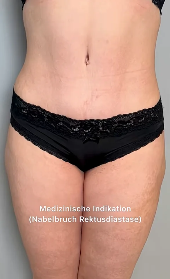 Bauchdeckenstraffung Nachher Bild