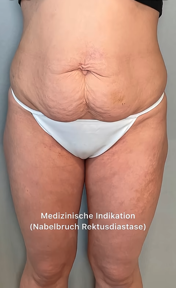 Bauchdeckenstraffung Nachher Bild