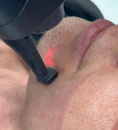 CO2-Laser-Behandlung in München
