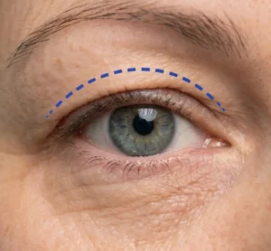 Oberlidstraffung Schnittlinie