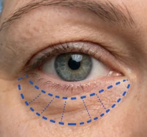 Unterlidstraffung Schnittlinie
