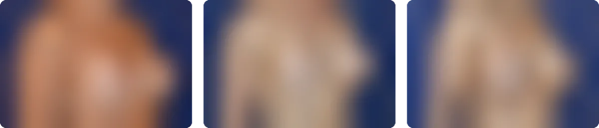 Bewusst unkenntlich gemachte Vorschau auf drei Ergebnisbeispiele der Brustvergrößerung